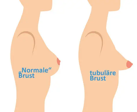 Tubuläre Brust